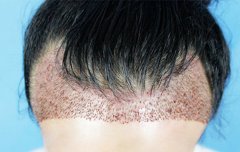 脱发问题植发能决绝吗？
