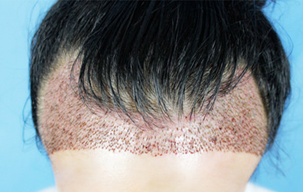 脱发问题植发能决绝吗?