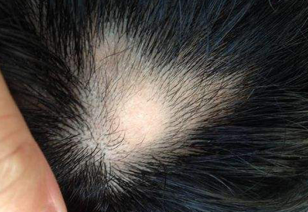 那些情况不能做植发？　