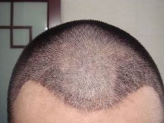 植发后应该怎样安全度过？