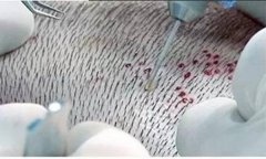 什么是无痕植发？