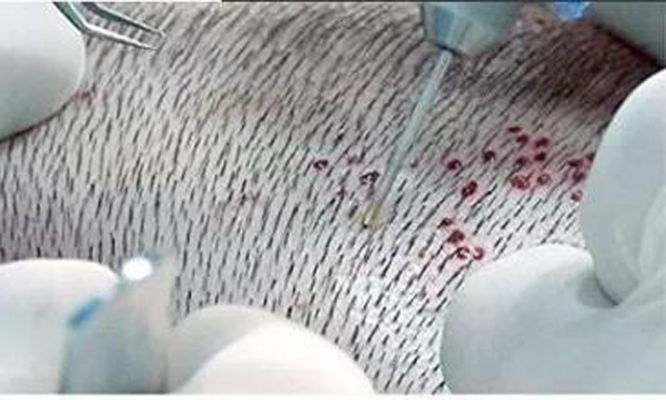 什么是无痕植发?