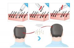 无痕植发都有什么优势呢？