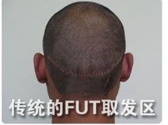 FUT是什么植发技术效果怎么样？
