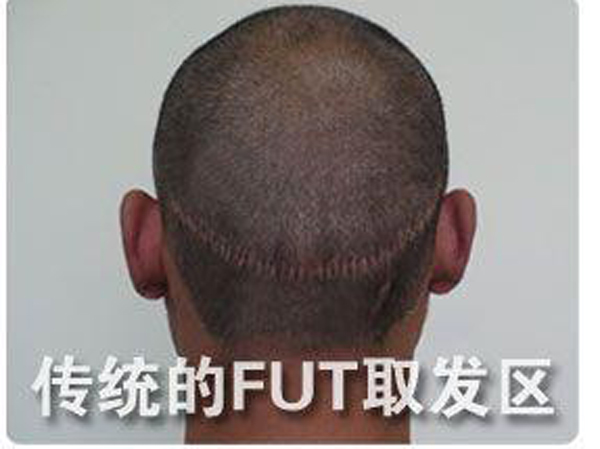 FUT是什么植发技术效果怎么样?