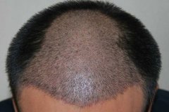 移植后的头发还会在掉落吗？