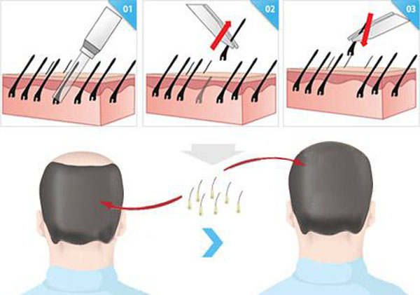 植发你想了解什么