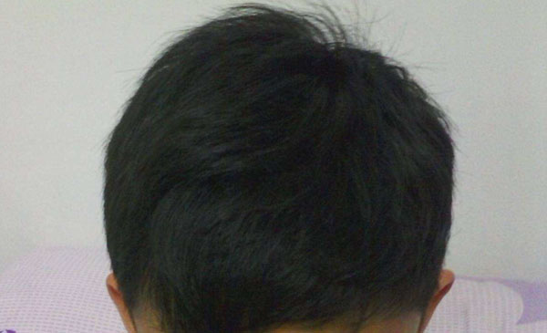 植发对身体健康有影响吗?