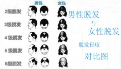 女性3级脱发植发效果怎么样？
