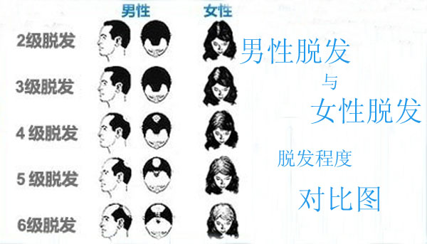 女性3级脱发植发效果怎么样?