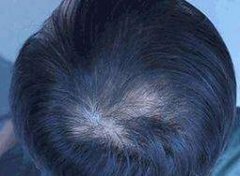 头发稀疏使用增发纤维有效果吗？