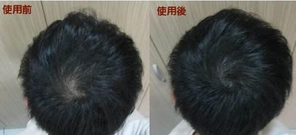 增发纤维是什么？有治疗脱发的效果吗？　