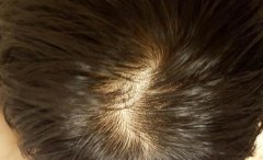 头发稀疏治疗方法有什么？