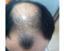 密发纤维脱发严重能使用吗？
