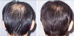 植发后头发稀疏有什么方法可以改变？