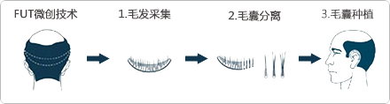 国内的植发技术FUE和FUT的区别！　