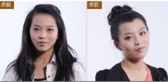 女性植发效果怎么样？