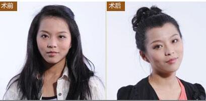 女性植发效果怎么样?