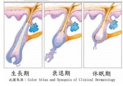 植发是如何进行的呢？