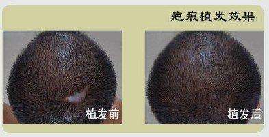疤痕性脱发植发效果前后对比图