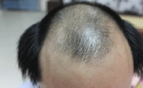 植发可以使用他人的头发吗?