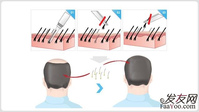 无痕植发、植发后应该怎么护理？　