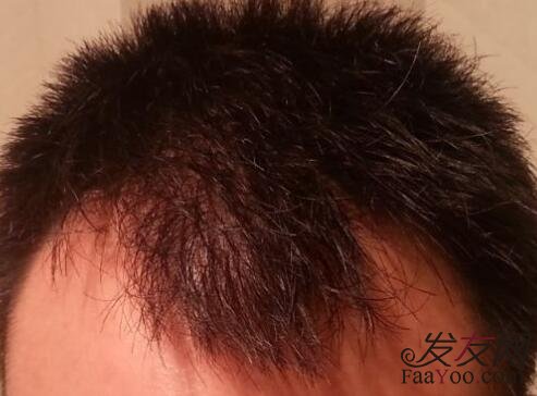 脱发植发真的安全吗?