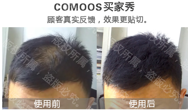 植发后头发稀疏有什么方法可以改变?