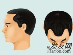 植发各位脱发患者你都了解什么？