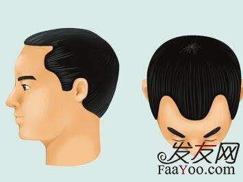 植发各位脱发患者你都了解什么?