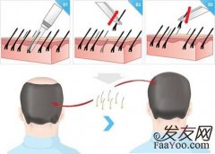 植发技术有什么？