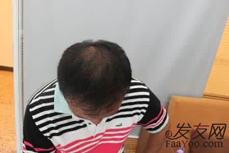植发会失败吗?有应该怎么看待?