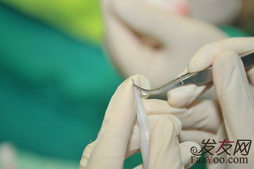 对于植发都了解什么？　