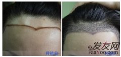 不脱发发际线高能植发吗？