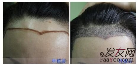 不脱发发际线高能植发吗?