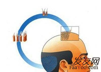 植发后的头发能够永久不掉吗?