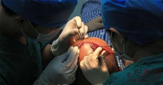 植发怎么样你知道吗?