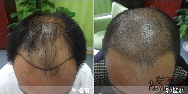 能否植发应该怎么选择?