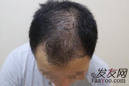 脱发选择植发真的好吗?