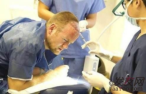 植发各位真的都了解吗?