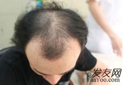 植发是什么？你们知道？