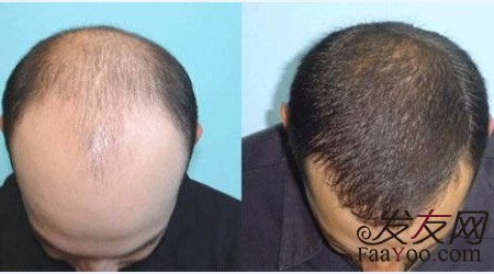 植发你了解什么?