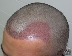 使用植发治疗可靠吗？