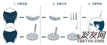 植发治疗脱发都有什么好处？　