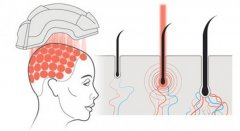 熊二答疑：用激光头盔治疗脱发，是否真的有广告说的那么好？