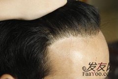 植发的效果怎么样呢？