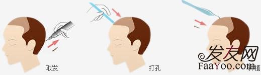 植发能够彻底治疗脱发吗?