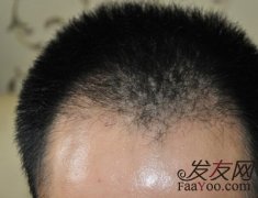 脱发使用植发有没有危害？