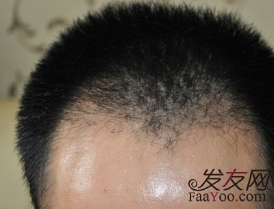 脱发使用植发有没有危害?
