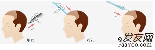 植发技术各位都了解吗?